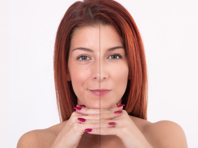 Imagem do procedimento de Botox